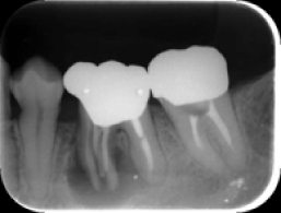 骨補填（x-ray写真）手術前